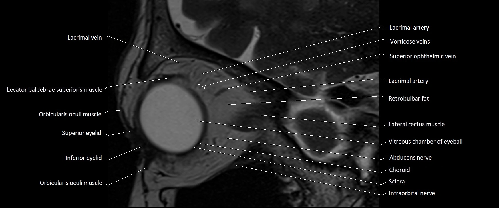 MRI Orbit sagittal cross sectional anatomy 3T image 13.webp